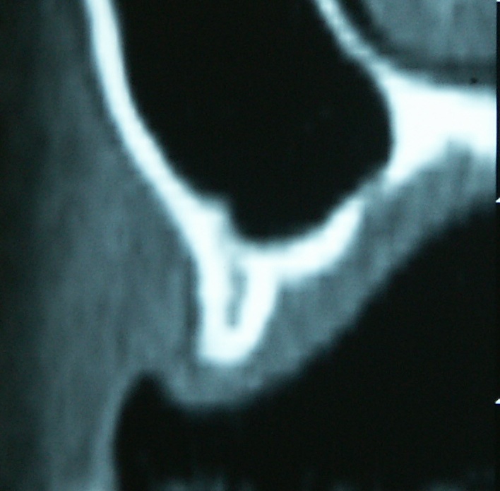 上顎洞CT