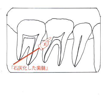 虫歯治療歯髄