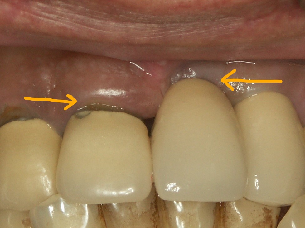 前歯のインプラント1