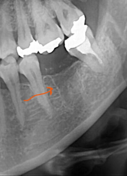 歯槽骨線