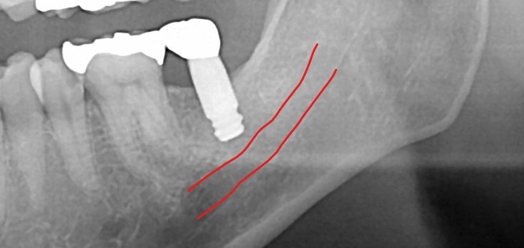 下顎奥歯のインプラント写真4