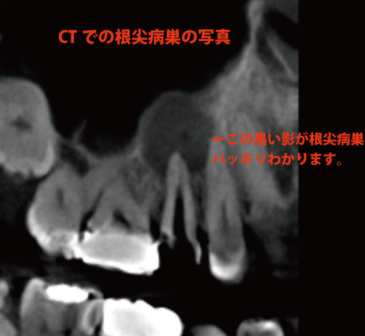 根尖病巣CT写真