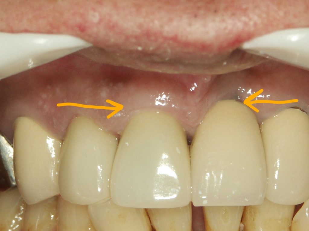 前歯のインプラント2