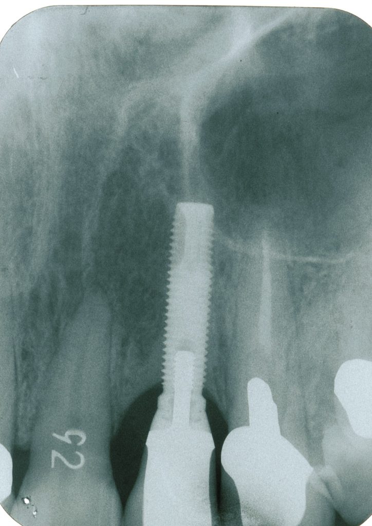 前歯の骨吸収